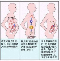 如何预防新生儿溶血症的发生和发生