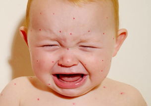 预防婴儿湿疹的方法有