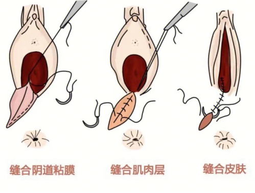 顺产撕裂伤口如何促进恢复快