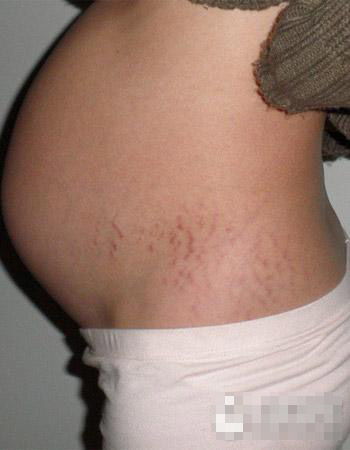 孕期怎样防止妊娠纹