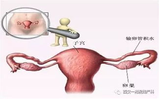 输卵管通畅性检查